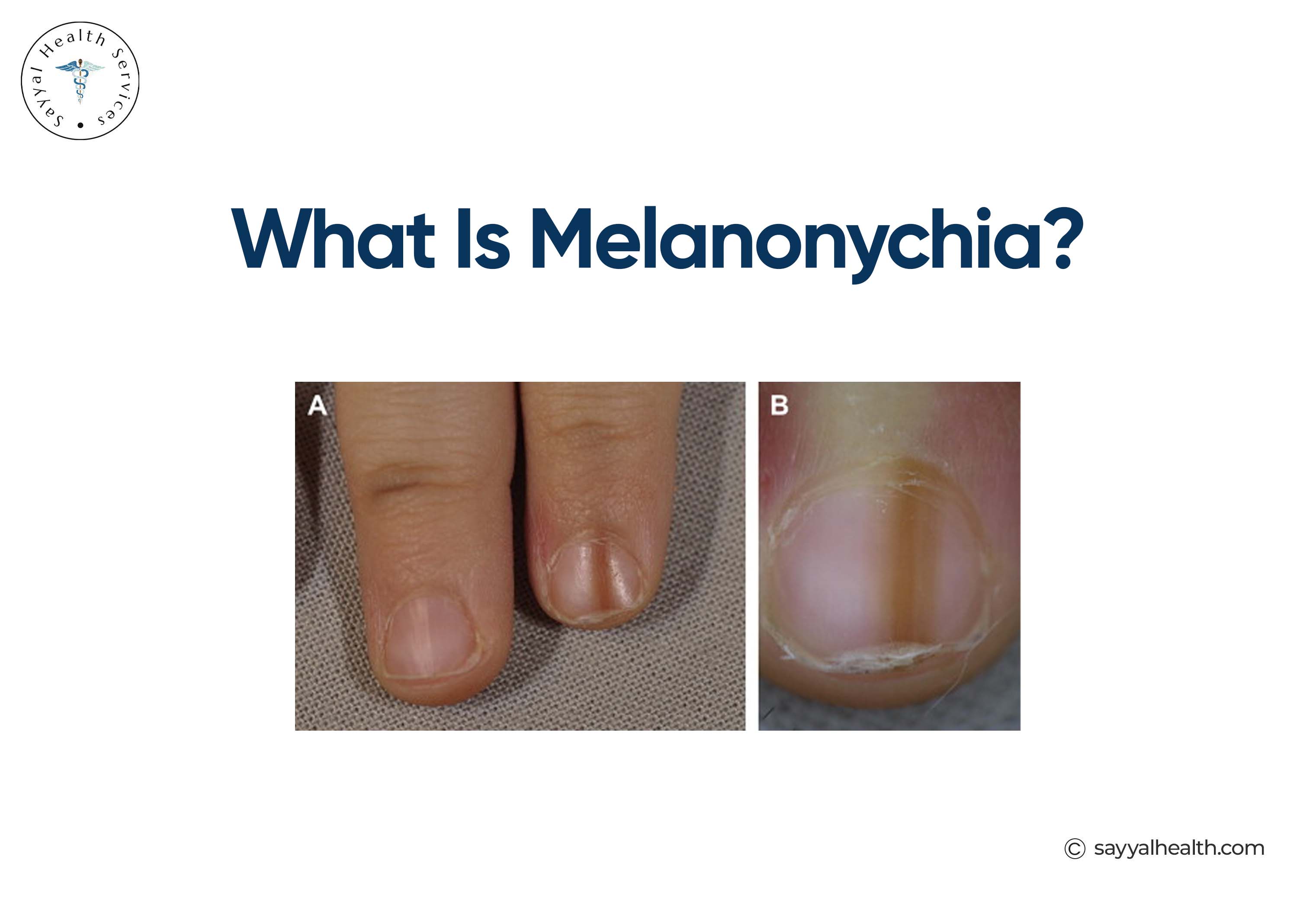 what is melanonychia?